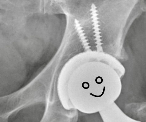 X-ray image of a hip joint replacement with a smiley face added for a whimsical effect.